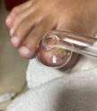 Aparelho de alta frequência para fungos
