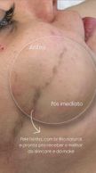 Dermaplaning