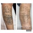 Remoção tattoo 