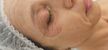 Blefaroplastia sem cortes	