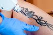 Remoção de tatuagem até 5cm