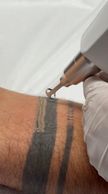 Remoção de tatuagens 