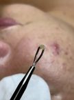 Limpeza de pele profunda
