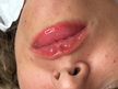 Hydra Lips ( com ou sem coloração no lábio ) 
